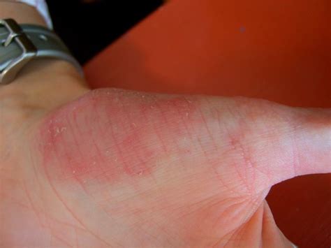 Peeling skin on hands affects millions of people in the world. Painful and dry cracked hands are reliably treated with ...