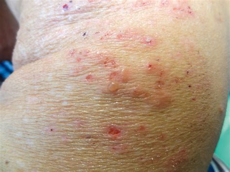 Dermatitis Herpetiformis As Related To Cetirizine Pictures