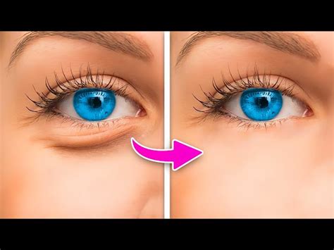 How To Reduce Under Eye Bags Without Surgery