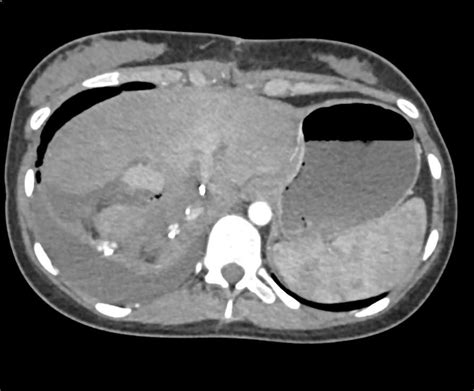Liver Laceration In The Liver Trauma Case Studies Ctisus Ct Scanning