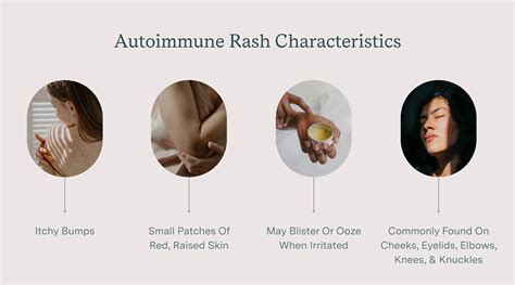Autoimmune Rash Causes Types Side Effects And Treatment