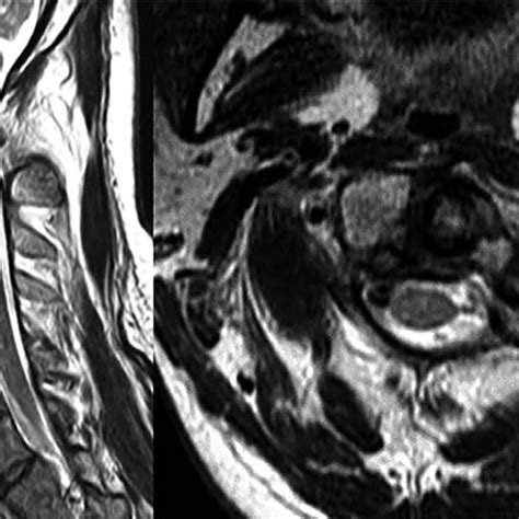 Preoperative Cervical Magnetic Resonance Image Without Contrast