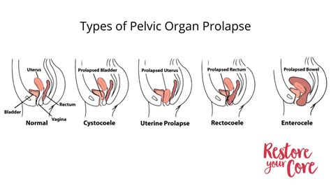 Pelvic Floor Specialist Finding Help To Heal Your Pelvis Ryc®