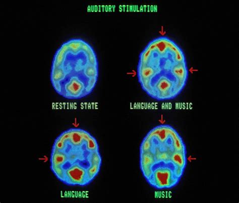 Brain Scanning Mri Ct And Pet Imaging Britannica