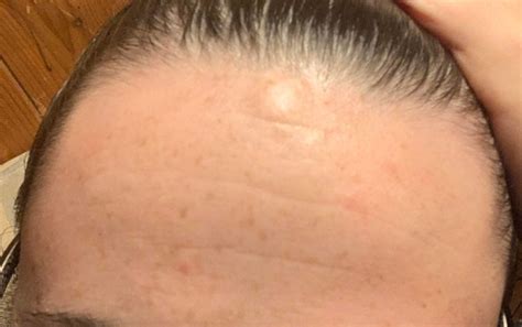 So I Have A Lump Growing Out Of My Forehead Photo What Could It Be