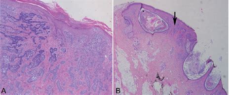 Epidermal Cyst Formation And Hyperkeratosis In A Patient Treated With