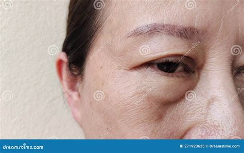 The Flabby Wrinkles And Ptosis Beside The Eyelid Stock Image Image Of