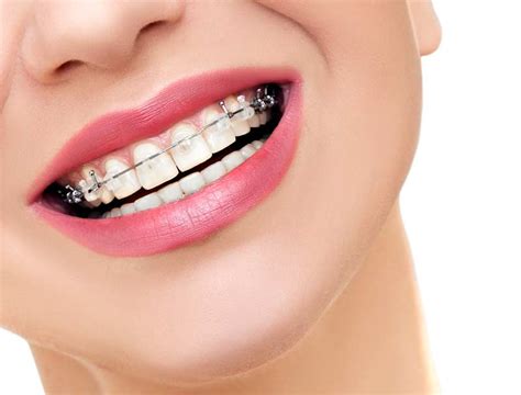 Types Of Braces Orthodontist Ottawa ON Centrepointe Orthodontics