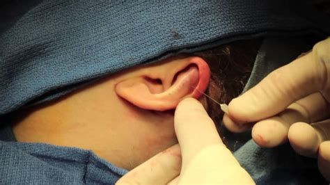 Operate Now Ear Surgery Stapedectomy Youtube