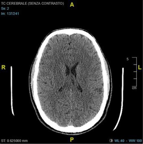 Normal Brain Ct Scan At The Entrance Download Scientific Diagram