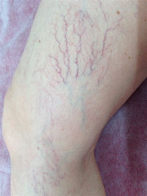 Spider Vein Treatment Brisbane Results — The Leg Vein Doctor Brisbane