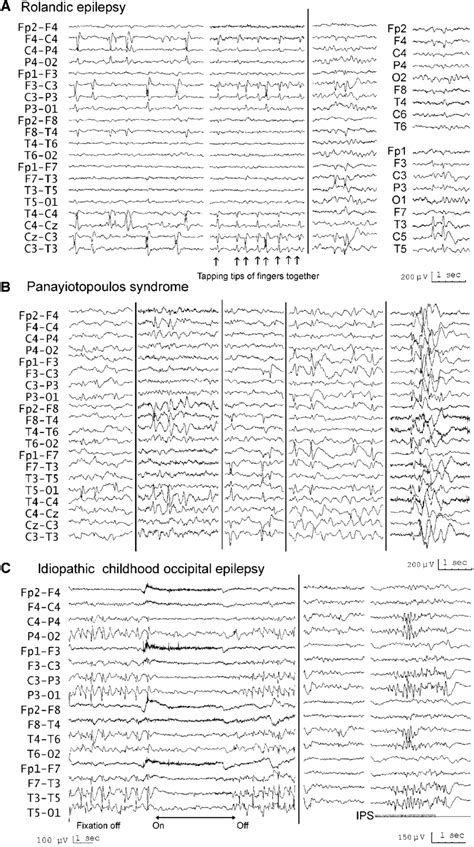 Interictal Eeg In Rolandic Epilepsy Top Ps Middle And Idiopathic