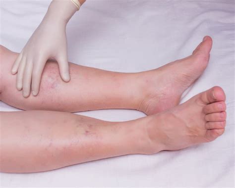 Leg Edema Symptoms Causes And More Plusvitality