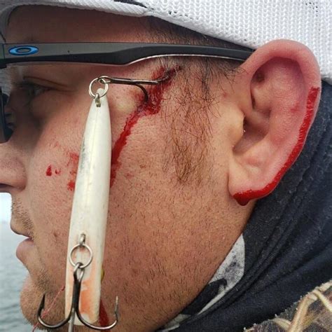 How to tie a fish hook. Photos: The Worst Fish Hook Injuries to MeatEater Fans ...