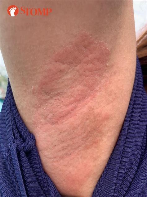 Woman Left With Scars After Allergic Reaction To 300 Waxing Treatment