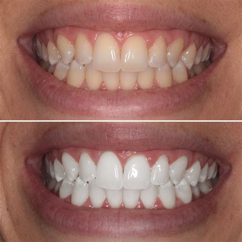 Top 103 Pictures Tooth Whitener For Photos Superb