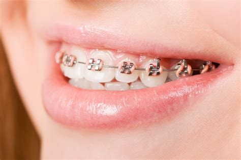 We did not find results for: How to Get FREE Braces in Australia | The No Cost Option ...