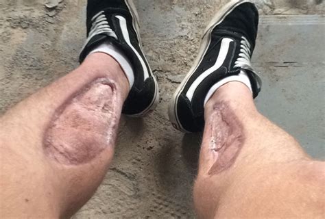 Pain with certain movements, particularly. Lower extremity compartment syndrome in the setting of ...