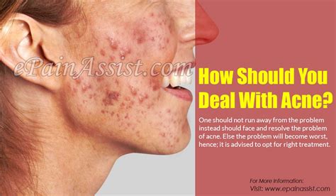 How Should You Deal With Acne