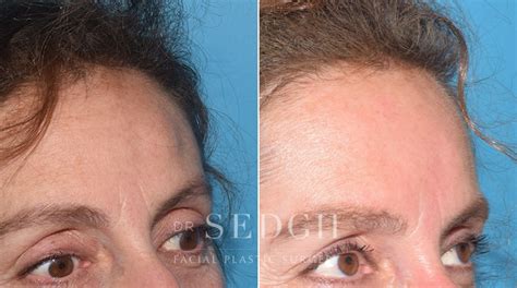 Endoscopic Osteoma Removal Before And After Photos Dr Sedgh