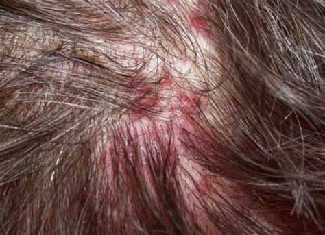 Itchy Scalp Causes With Hair Loss Treatments And Remedies Strong Hair