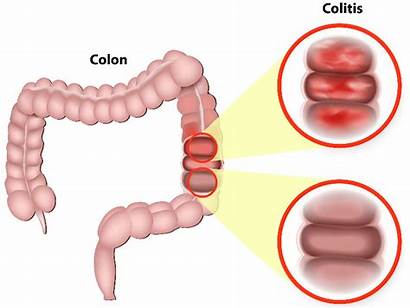 Colitis Ulcerative Left Colon Swollen Sided Causes