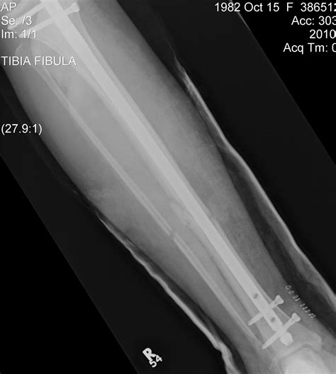 Midshaft Tibial Fracture The Bone School