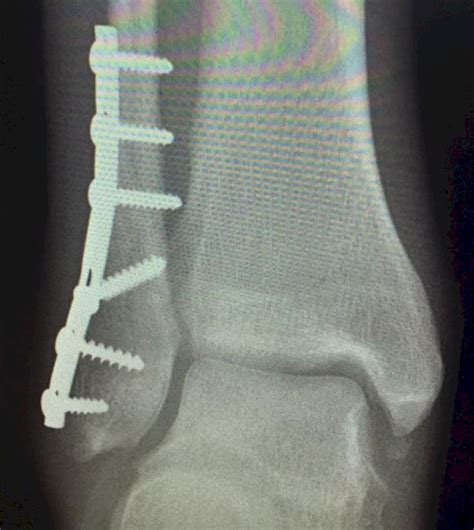Sports Docs Weekly Blitz Ankle Fractures