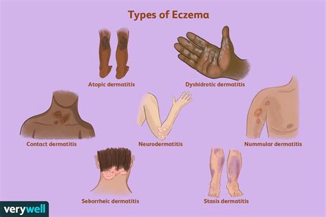 How To Describe Eczema On Physical Exam Erikamingarza