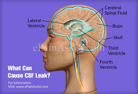 What Can Cause CSF Leak Is A CSF Leak Serious Cerebrospinal Fluid