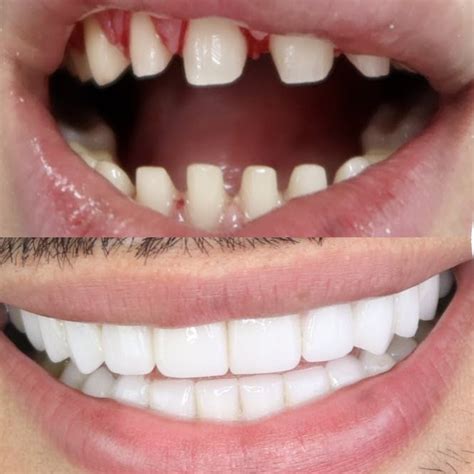 Do You Really Need To Get Your Teeth Shaved For Veneers The Teeth Blog