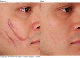 Laser Treatment To Remove Scars On Face Images