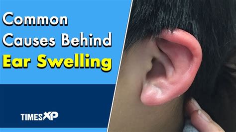 Ear Swelling Common Reasons Behind It Swimmers Ear Mastoditis