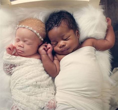 these twins have different skin colors 15 pics