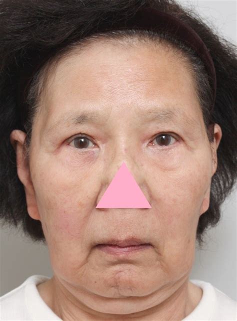 70代女性の顔にrf高周波エネルギーシステムを行い、たるみが改善した症例写真です。 美容整形高須クリニック 高須 幹弥 オフィシャルブログ