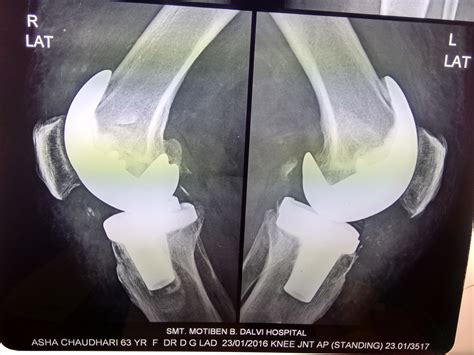 Bilateral Total Knee Replacement Tkr In An Obese Lady Bone And Joint Clinic