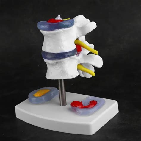 Anatomical Lumbar Disc Herniation Demonstration Model Human Spine