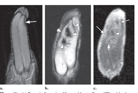 Figure 11 From Mr Imaging Of Nonmalignant Penile Lesions Semantic
