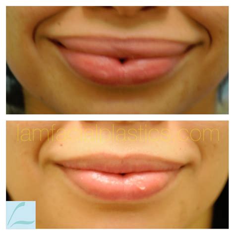 This Woman Had Unsightly And Unnatural Lip Augmentation With Silicone