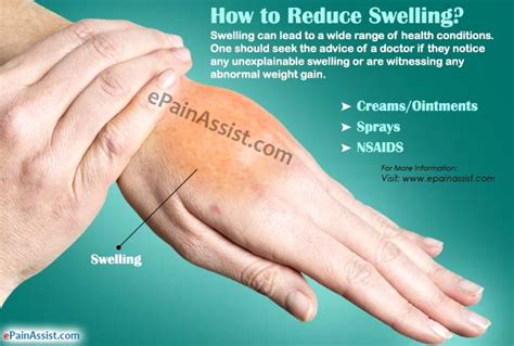 How To Reduce Swellingtreatmenthome Remediesfirst Aidfoods