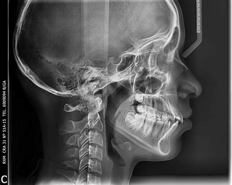 Radiograf As Extraorales Rxm Radiologia Maxilofacial