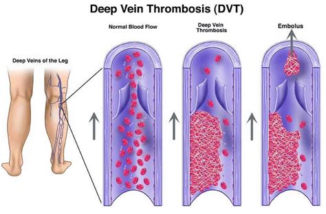 Venous Thromboembolism Definition Causes Symptoms Diagnosis Treatment