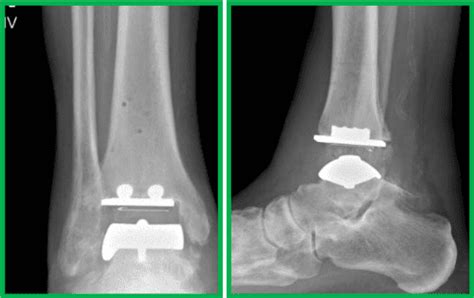 Ankle Joint Replacement Sarasota Fl Florida Orthopedic Foot And Ankle