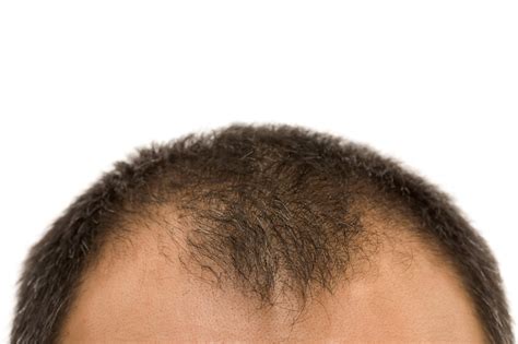 Top 3 Treatments For Male Pattern Baldness