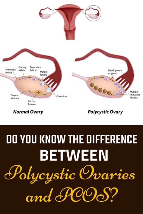 Do You Know The Difference Between Polycystic Ovaries And Pcos If You