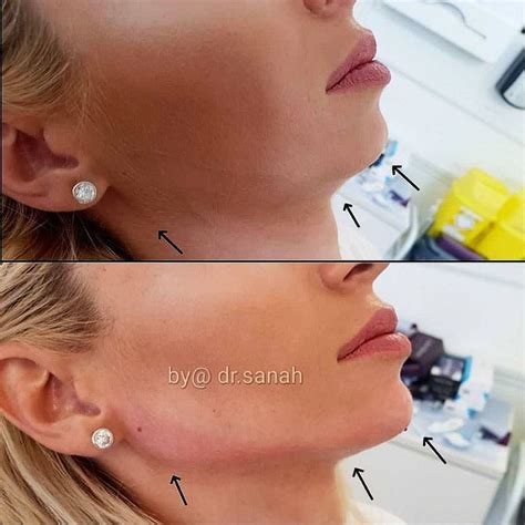 Jawline Contouring Hello New Sharp And Chiseled Jawline This Patient Flew In From Romania With
