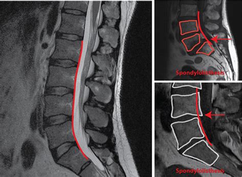 If you were to have. How To Understand Your Complex Spine MRI in 8 Easy Steps ...