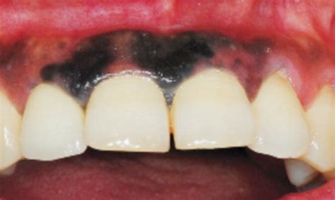 Woman Whose Gums Turned Black Is Diagnosed With Skin Cancer Of The