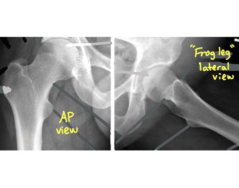 Radiographs Of The Hip Quiz