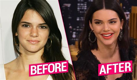 Kendall Jenners Plastic Surgery Exposed By Top Docs